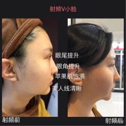 光SPA射频V小脸-光SPA科技美肤