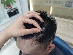 -大麦微针植发丨全国连锁