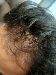 -碧莲盛·不剃发植发