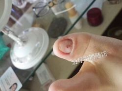 -德哥灰指甲脚气甲沟炎跖疣护理