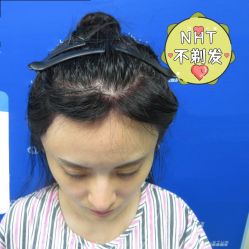 -碧莲盛·不剃发植发