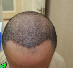 -大麦微针植发丨全国连锁