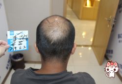 -大麦微针植发丨全国连锁