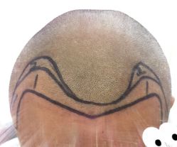 -大麦微针植发全国连锁