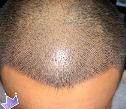 -大麦微针植发丨全国连锁