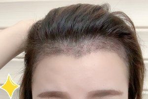 -大麦微针植发丨全国连锁