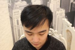 点击看大图 -大麦微针植发丨全国连锁