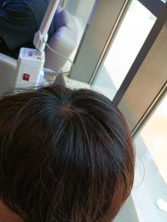 -碧莲盛·不剃发植发