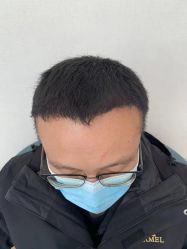 点击看大图 体验后-大麦微针植发丨全国连锁