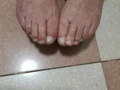 -世龙世家灰指甲鸡眼脚气甲沟炎跖疣护理(通州店)