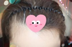 -大麦微针植发全国连锁