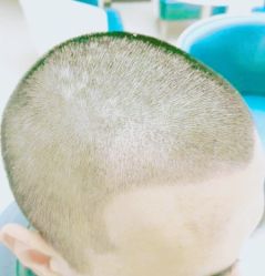 -大麦微针植发丨全国连锁