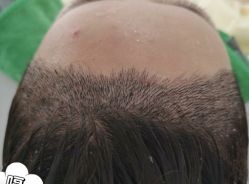 -大麦微针植发丨全国连锁