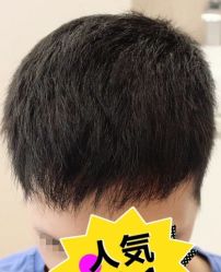 -大麦微针植发丨全国连锁