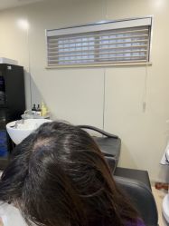 -碧莲盛·不剃发植发