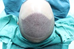 点击看大图 -大麦微针植发丨全国连锁