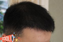 -大麦微针植发丨全国连锁