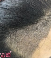 -大麦微针植发丨全国连锁