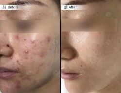 -美肤盾祛痘·问题肌头疗管理中心