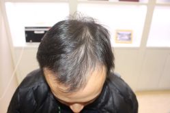 点击看大图 -大麦微针植发丨全国连锁