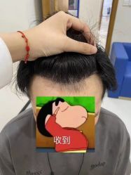 体验后-大麦微针植发全国连锁