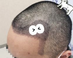 -大麦微针植发全国连锁