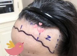 -大麦微针植发全国连锁