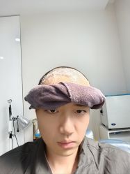 体验后-大麦微针植发全国连锁