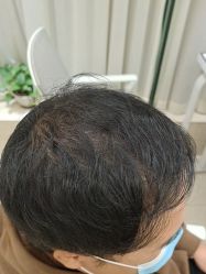点击看大图 -碧莲盛·不剃发植发