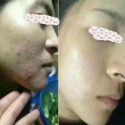 点击看大图 -苗方清颜·祛痘皮肤管理