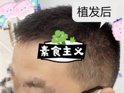 -大麦微针植发全国连锁