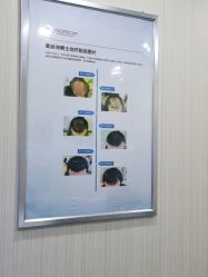 -碧莲盛·不剃发植发
