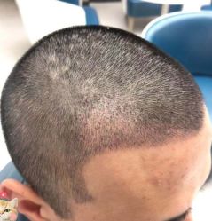 -大麦微针植发丨全国连锁