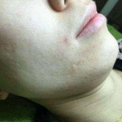 点击看大图 -苗方清颜痘肌研究所