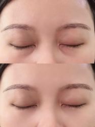 -广州健丽·去眼袋医疗美容机构