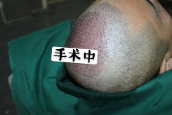 -大麦微针植发全国连锁