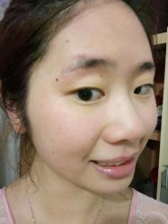 -美丽人生祛斑扁平疣汗管瘤中心