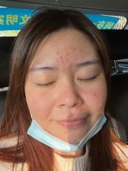 体验后-深圳春天阳光医院·轮廓抗衰中心