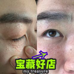 -美丽人生祛斑扁平疣汗管瘤中心