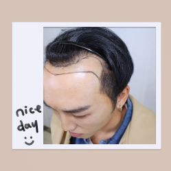 体验后-大麦微针植发全国连锁