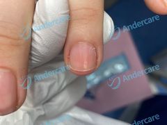 -Andrew指甲专科灰指甲·甲沟炎矫正·3D步态矫形鞋垫定制(浦三路店)