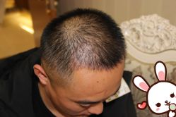 点击看大图 -大麦微针植发丨全国连锁