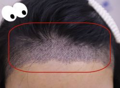 -大麦微针植发全国连锁