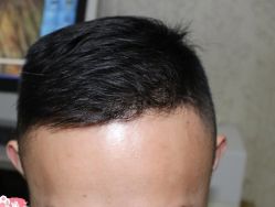 -大麦微针植发丨全国连锁