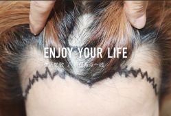 -大麦微针植发全国连锁