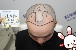 点击看大图 -大麦微针植发丨全国连锁