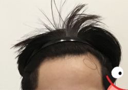 -大麦微针植发全国连锁