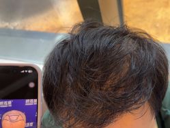 -碧莲盛·不剃发植发