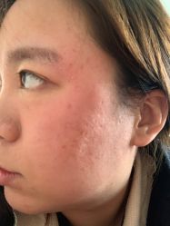 体验后-亿美医疗美容·半岛大超炮官方授权店