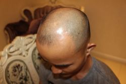 -大麦微针植发丨全国连锁